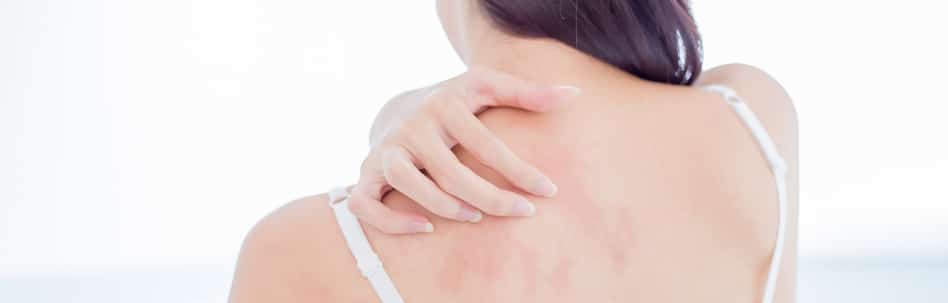Eczema Treatment Tampa FL