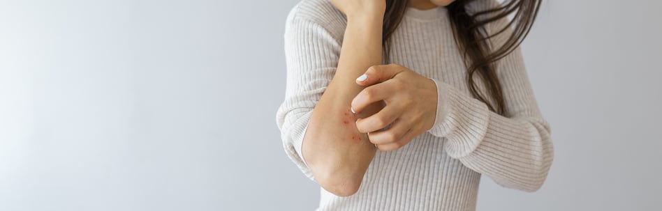 psoriasis treatment tampa fl
