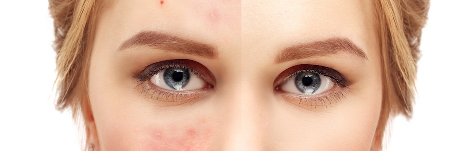 rosacea treatment tampa fl