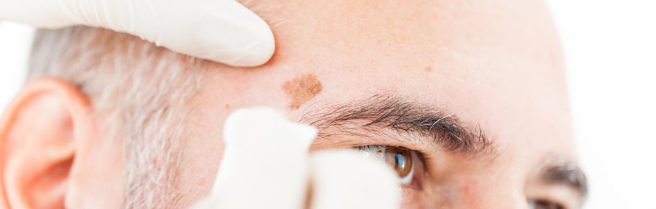 actinic keratosis treatment tampa fl