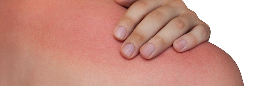 sun damage treatment tampa fl