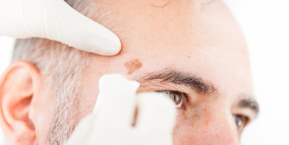 clinical dermatology for actinic keratosis tampa fl