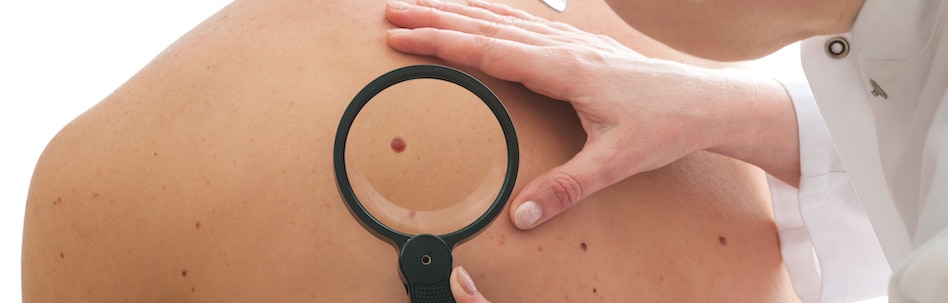 moles removal tampa fl