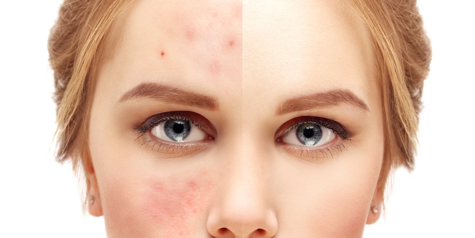 clinical dermatology for rosacea dade city fl