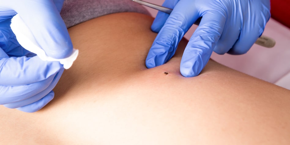 clinical dermatology for warts tampa fl
