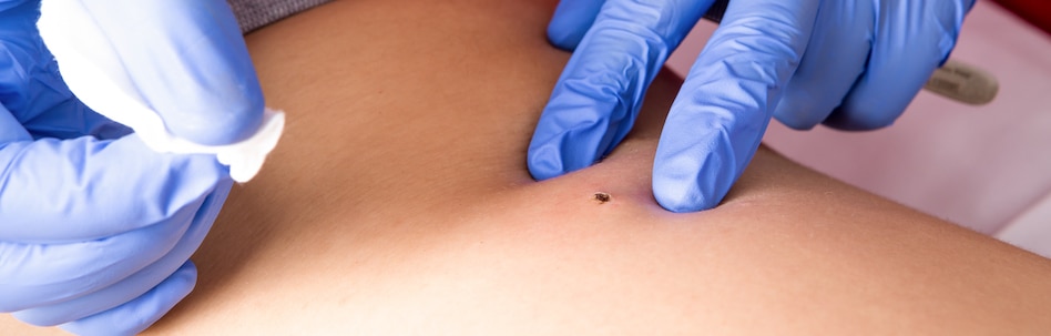 warts removal tampa fl