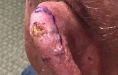 gentlecure procedure tampa fl