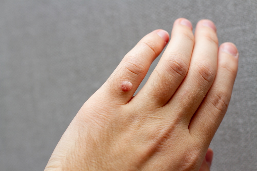 Warts Removal Treatment Tampa FL