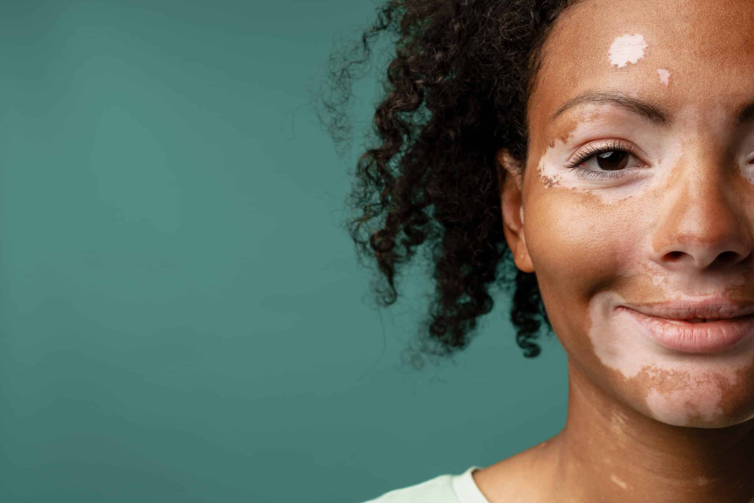 Vitiligo Treatment Dade City FL