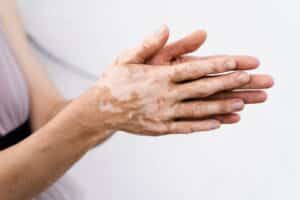 Skin Depigmentation Tampa FL
