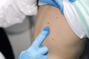 Skin Cancer Treatment Dade City FL