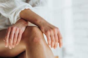 Psoriasis on a woman's hands and knees