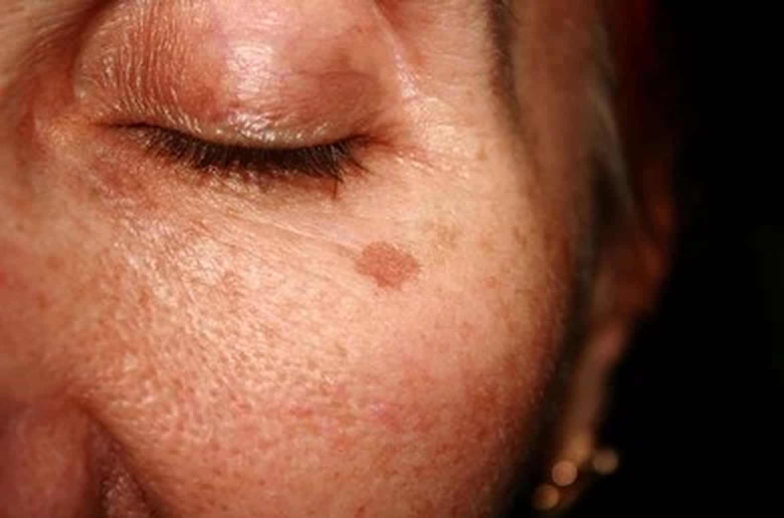 A close-up shot of sun damage on a woman's cheek