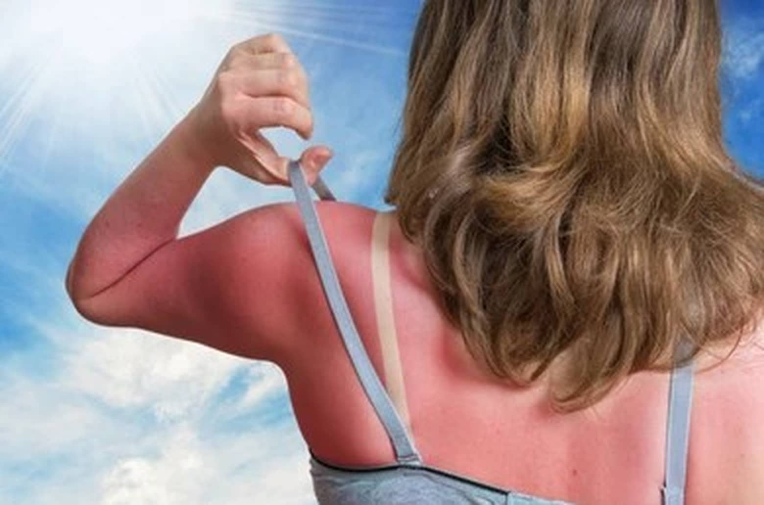 A woman with a severe sun burn on her back